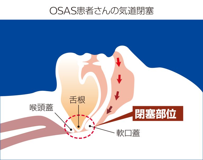 OSAS患者さんの気道閉塞　SASガイドイラスト-07